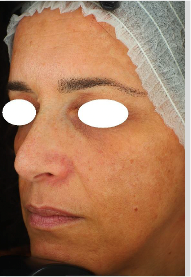 Antes